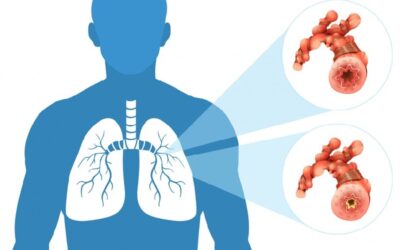 How to Detect Lung Cancer