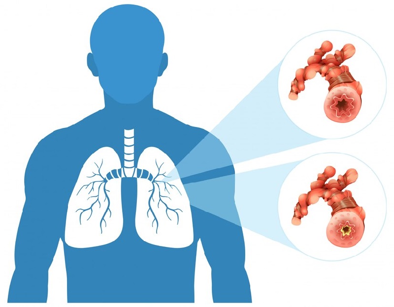 How to Detect Lung Cancer