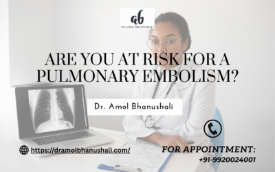 Are You at Risk for a Pulmonary Embolism?
